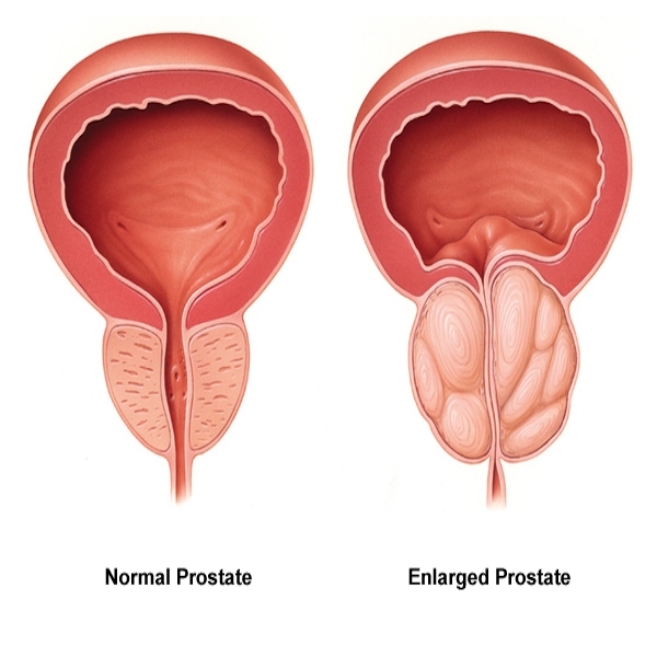 Are BPH and erectile dysfunction related